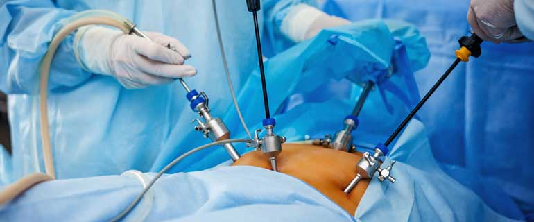 Laparoscopy